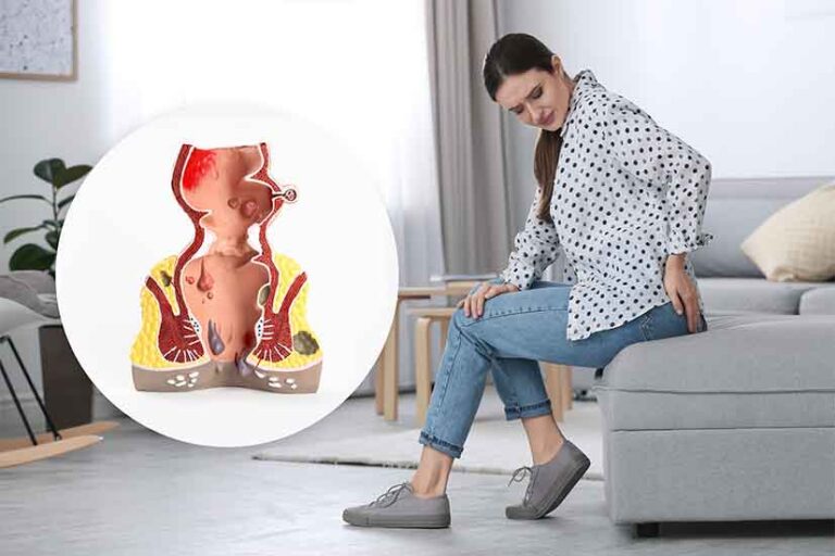 Piles in Women Symptoms, Treatment, & Piles Surgery in India