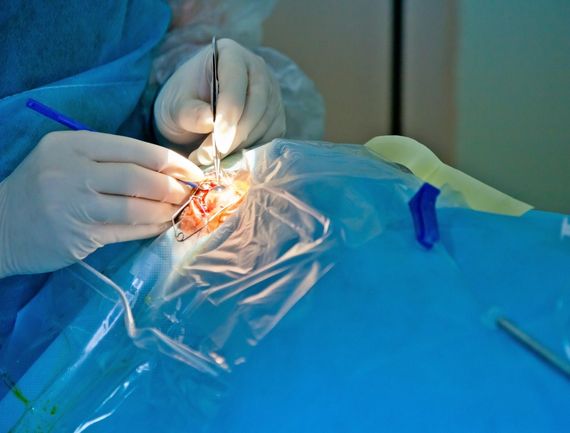 Cataract surgery in delhi