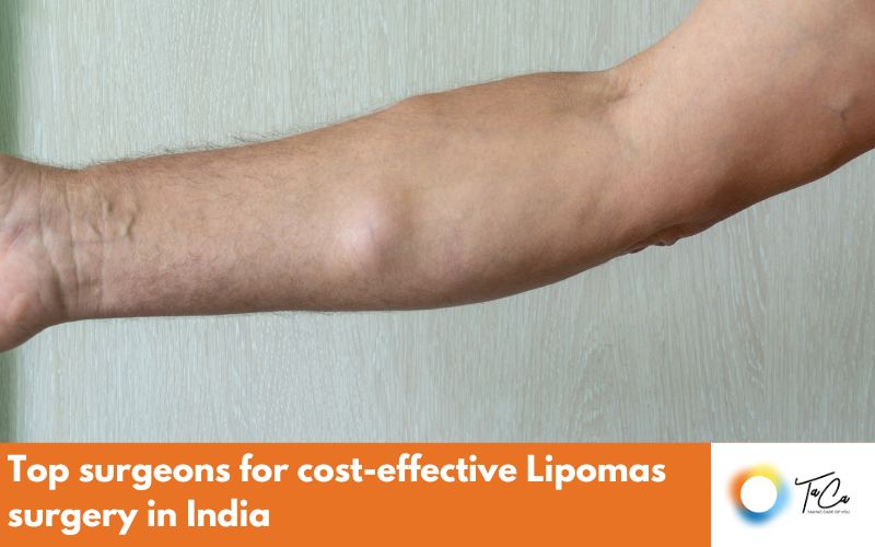 Top surgeons for cost-effective Lipomas surgery in India