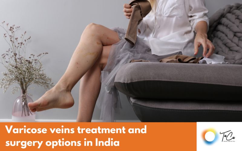 Varicose veins treatment and surgery options in India