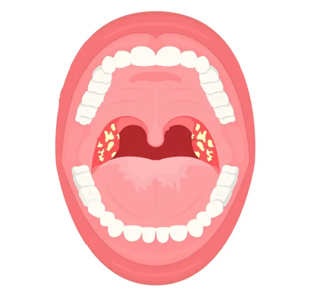 Adenoids and Tonsils Surgery