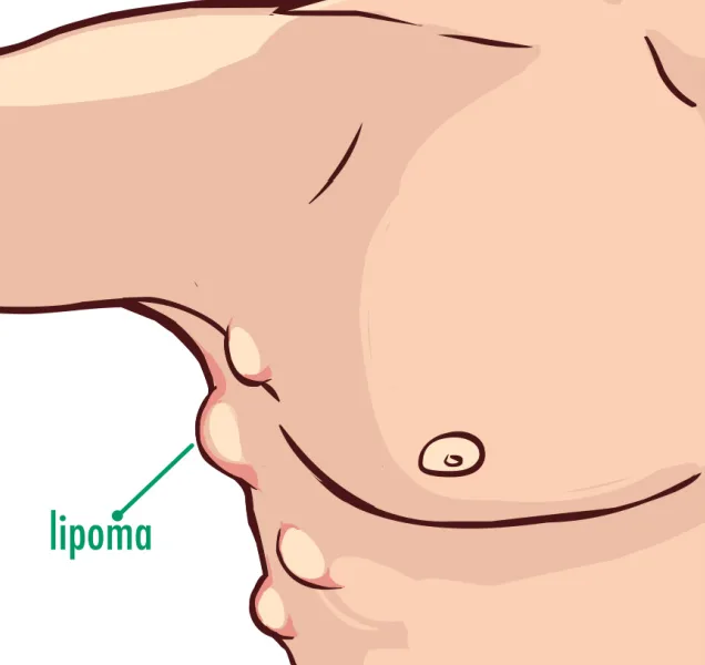 Lipoma Surgery