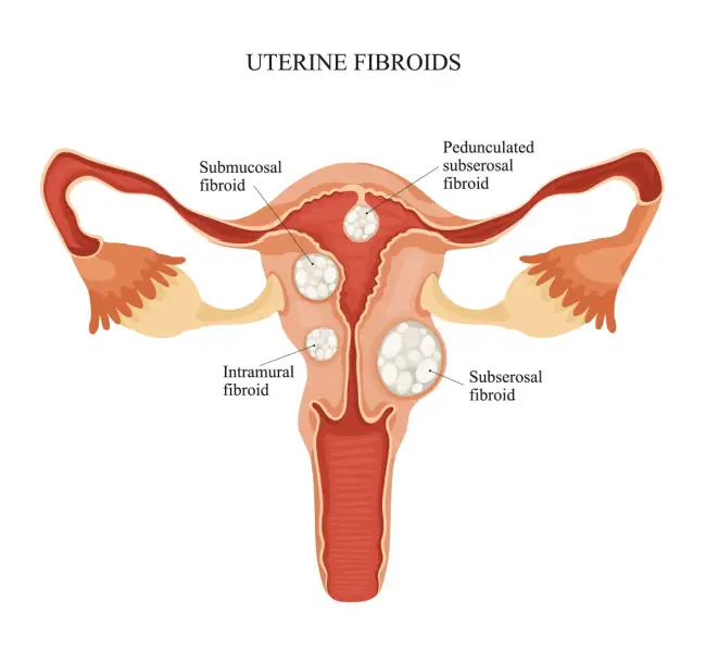 Uterine Fibroid Surgery